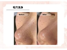 アルゴ 福津店(ALGO)/毛穴洗浄+幹細胞導入
