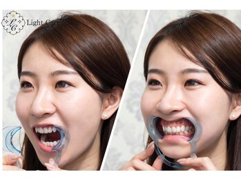 ライトケアサロン 渋谷店(Light Care Salon)/５ オープナーを装着
