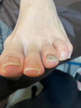 ダメージを受けた爪before