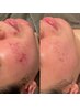 【ニキビケア人気No1メニュー】コスパ◎じっくり肌質改善　 ¥13000