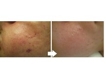 サロンドエステケイワイ(de KY)/フェイシャル☆ニキビ改善