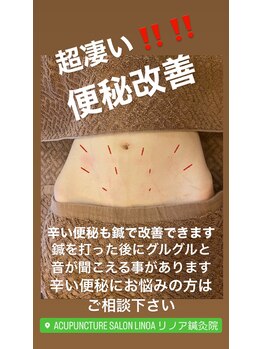 リノア鍼灸院(LINOA)/美腸鍼