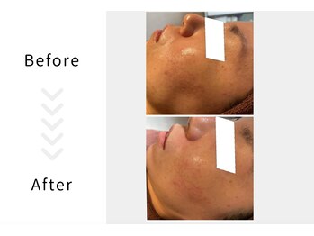 アブニールブリヨン/ハーブピーリング　Before After