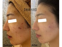 マスカレード 品川(Masquerade)/【症例写真】施術1回