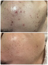 リノ(Lino)/男性ニキビケア♪