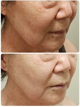 庭夢エステ/若見え｜70代でもここまで激変！