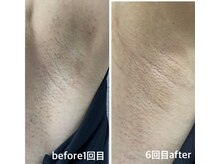 セルフメイド 石巻店/【ビフォーアフター】セルフ脱毛