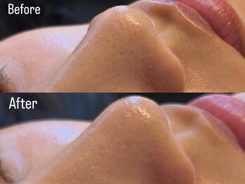 トム(Thom)/ハーブピーリングで毛穴汚れ改善