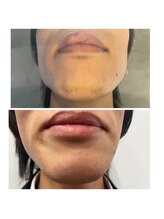 ディシェーレ アスト/ヒゲ脱毛