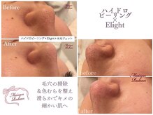 メゾンリュバン 梅田店(Maison Ruban)/毛穴洗浄・美白フォト|毛穴ケア