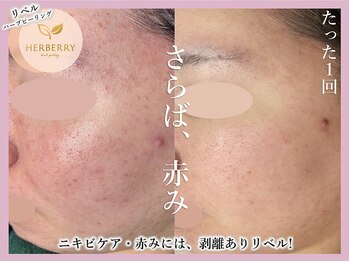 ハーバリー ハーブピーリング 大阪梅田店(HERBERRYハーブピーリング)/梅田ハーブピーリングHERBERRY