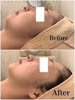 スペチアーレ 夙川/たるみ改善小顔になれる!