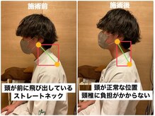 いちかわ守谷整骨院 はりきゅう院/ストレートネックの施術効果