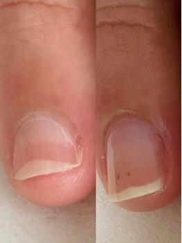 シーネイル(C Nail)の写真/『3ヵ月でかわる！！』コンプレックスだった爪が見せたくなる美爪に♪深爪・噛み爪・むしり爪も改善◎
