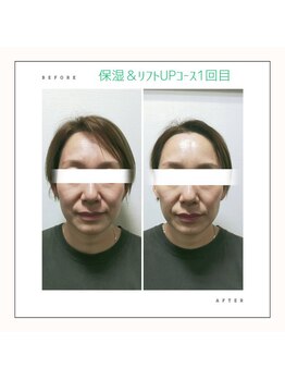 ビーフル バイ ブリリアントヘアー(beafull by brilliant hair)/フェイシャルエステbeforeafter