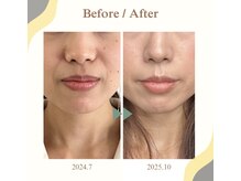 サロン ド メタセコイア(salon de Metasequoia)の雰囲気（根本から変わる、肌質改善スキンケア☆３０代後半女性）