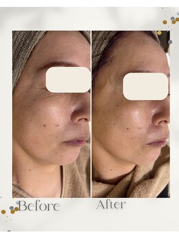 ブレス(Breath)/気になるお顔のハリ感