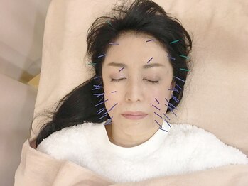 こじま 富雄団地接骨院/目の下のたるみ改善☆美容鍼