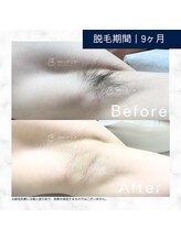 メンズクリア 武蔵小杉店/【メンズクリア】お客様の施術例