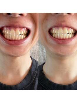 リコリス(Lycoris)/ホワイトニング/ホワイトニング