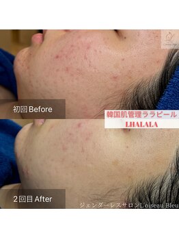 ロワゾーブリュ 代官山店(L'oiseau Bleu)/ニキビケアや赤みの鎮静