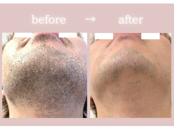 アネーロ(anhelo)/メンズヒゲ脱毛！