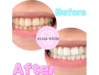 エクシアホワイトニング 武蔵小杉店/ビフォーアフター