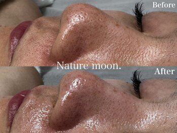 ナチュールムーン(Nature moon.)/毛穴洗浄