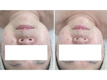 クロエクロウ(chloe'crow)/コルギで小顔