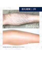 メンズクリア 武蔵小杉店/【メンズクリア】お客様の施術例