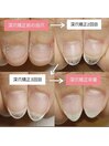 深爪矯正/3ヶ月のお爪の成長記録