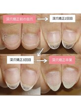 マニエネイル(mani e nail)/深爪矯正/3ヶ月のお爪の成長記録