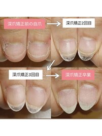 深爪矯正/3ヶ月のお爪の成長記録