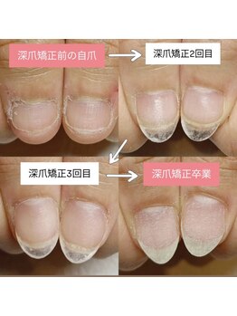 マニエネイル(mani e nail)/深爪矯正/3ヶ月のお爪の成長記録