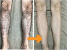 メロウ(mellow)/メンズ脚☆8回施術