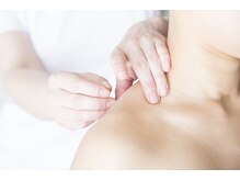 首、肩こり、眼精疲労、頭痛には鍼灸で根本改善。