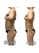 エリクシア 松戸/30代全身痩身5回目(お腹と背中)