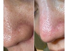 サイ(Sai)/花粉で揺らぐ肌にも毛穴ケア