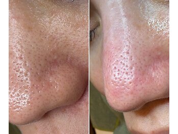 サイ(Sai)/花粉で揺らぐ肌にも毛穴ケア