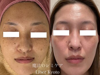エステティック リベル キョウト 京都駅前店(Esthetic Liber Kyoto)/魔法のシミケア