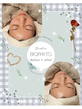 ハレル(Hareru)/Before…After(17)　BIOPHYTO