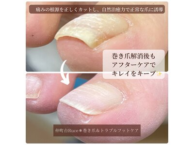 巻き爪でお悩みの方、是非ご相談ください！ネイルトリム＆BS取扱