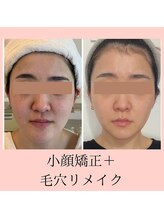 リセ(RESE)/肌改善＋小顔矯正コース一回