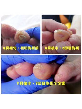 どうはく堂 西勝山接骨院/指先の魚の目