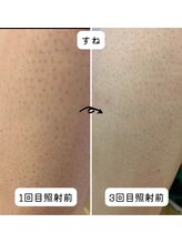 セルフメイド 石巻店/【ビフォーアフター】セルフ脱毛