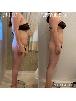 エイミー(Amy)/全身コルギ5回の変化