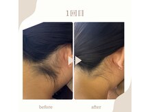 シャルム(Charme)/うなじ脱毛1回