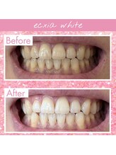 エクシアホワイトニング 岡崎店/白い歯で笑顔に★ホワイトニング
