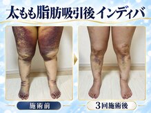 術後インディバ専門サロン 新宿