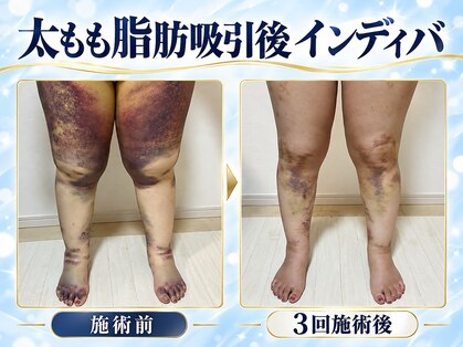 術後インディバ専門サロン 新宿の写真